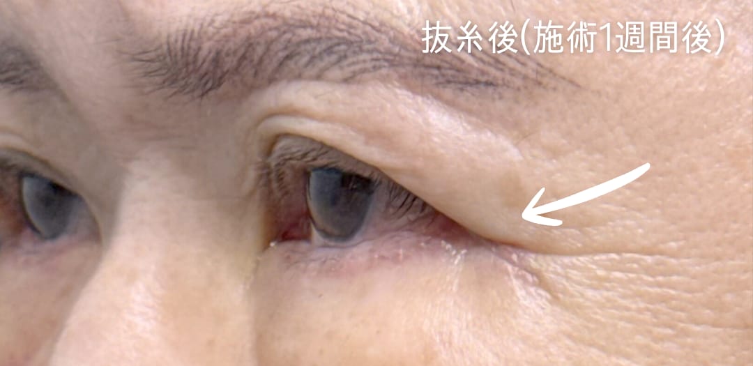 術後