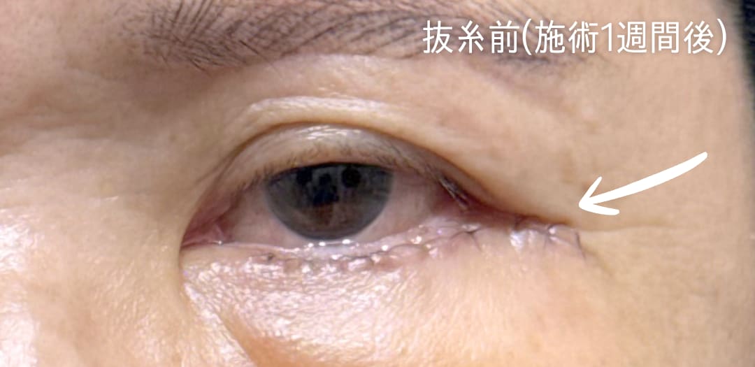 術前