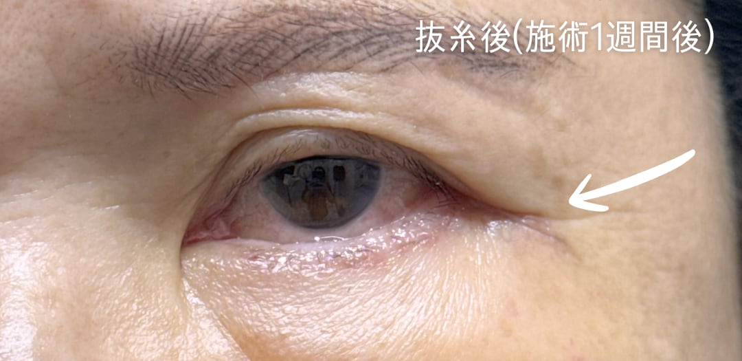術後