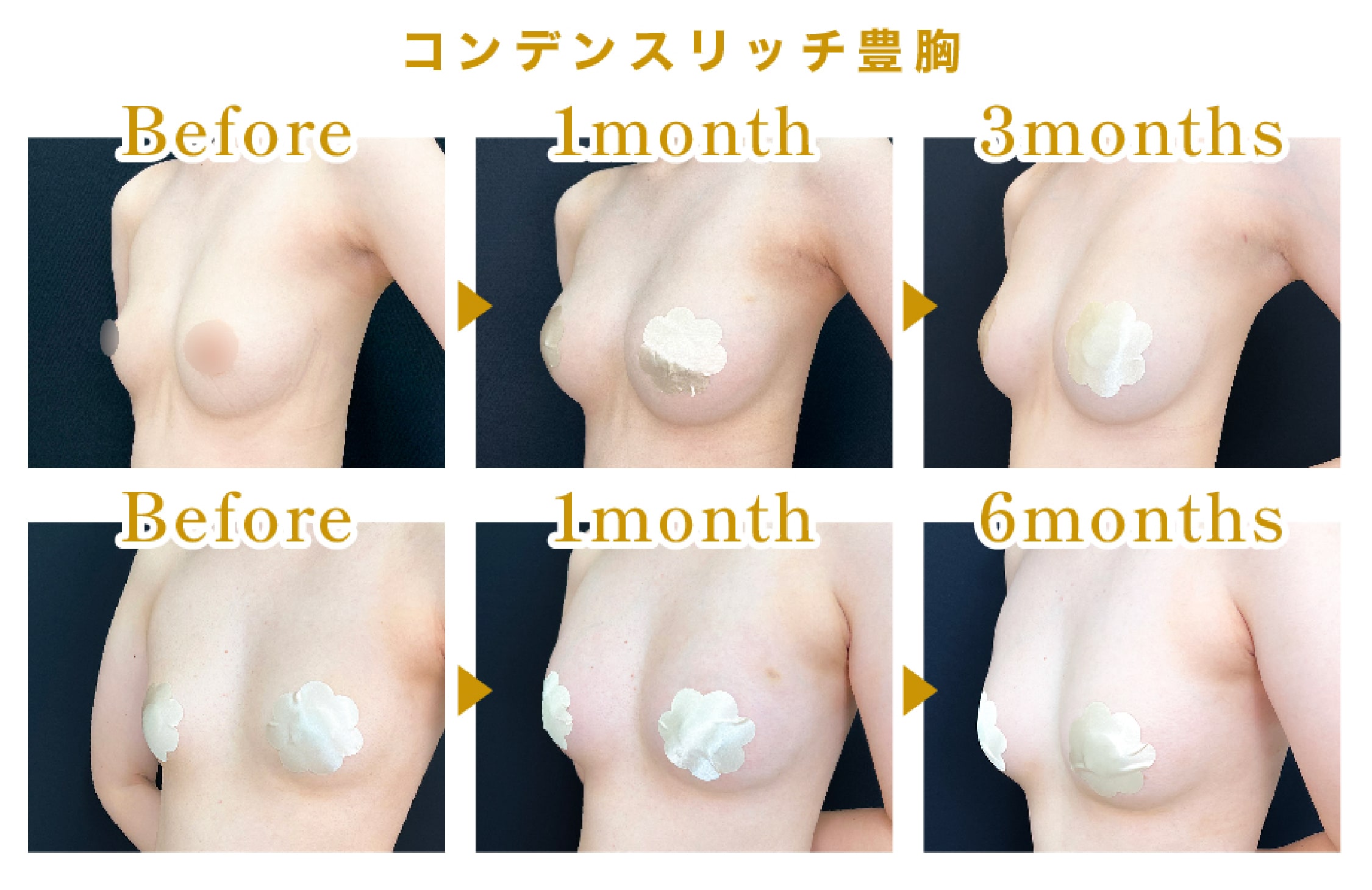 脂肪を最大限に活かす定着法
