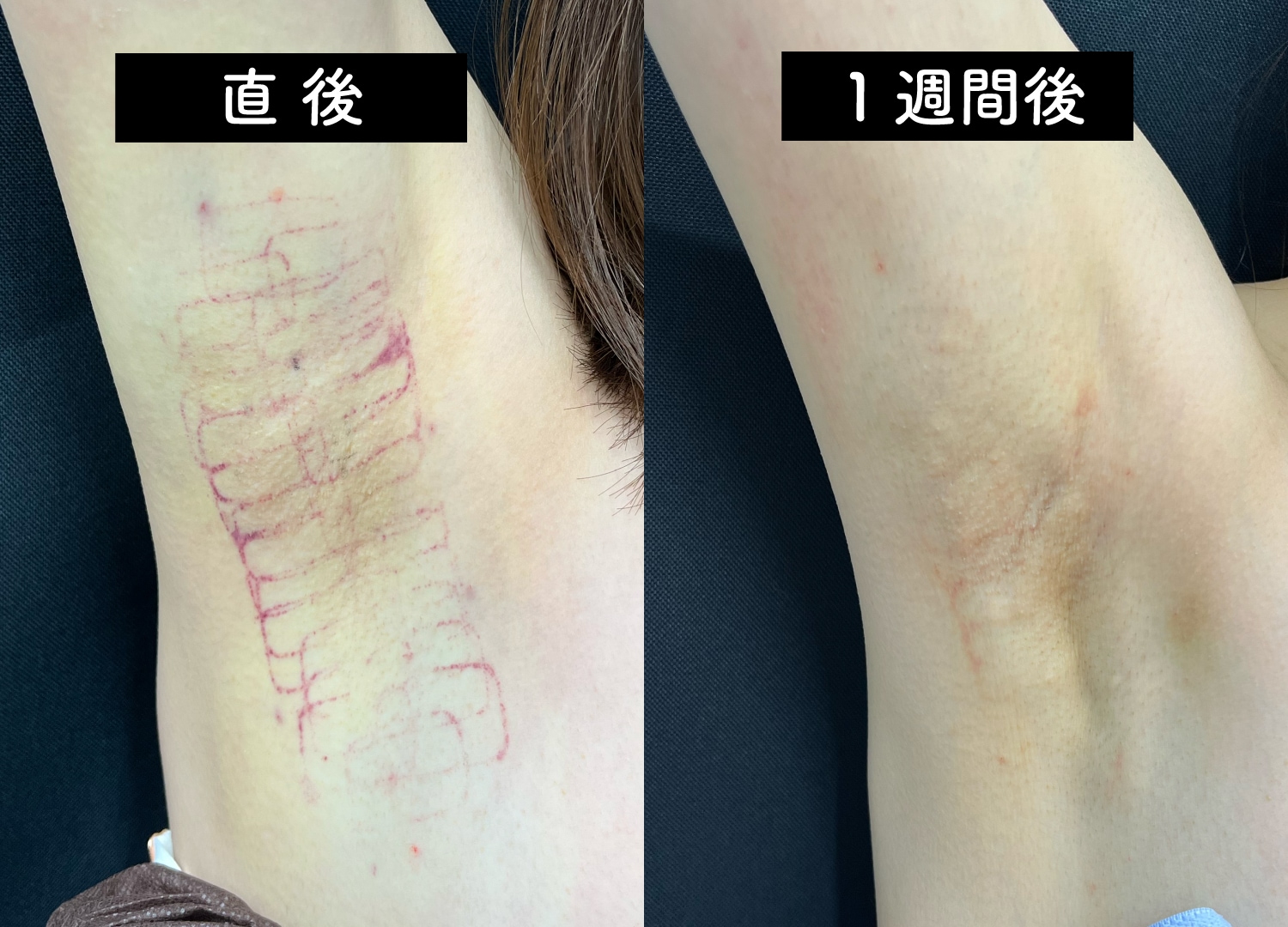【特徴1】傷跡が残らず、ダウンタイムも短い