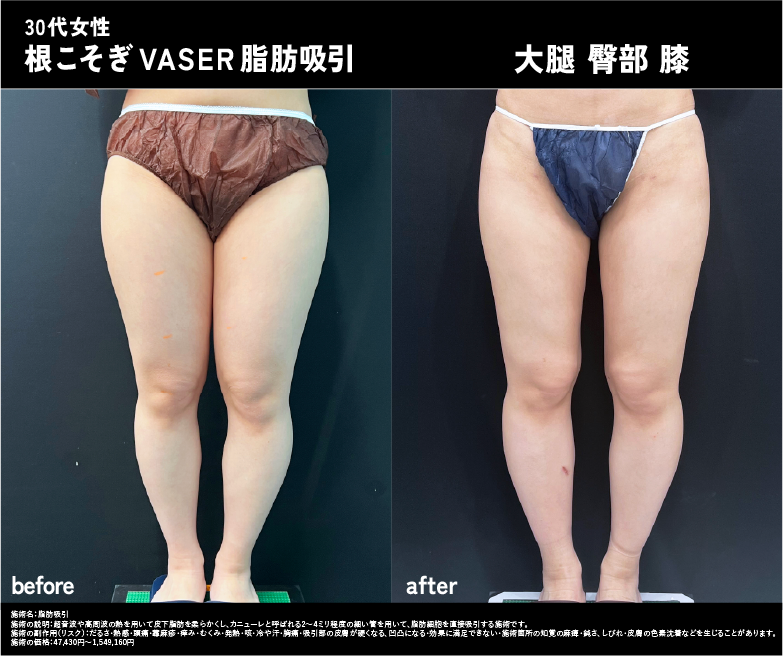 30代 根こそぎベイザー脂肪吸引症例