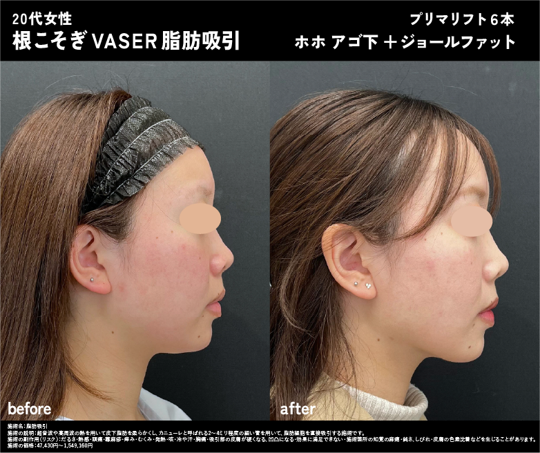 ２0代 根こそぎベイザー脂肪吸引症例