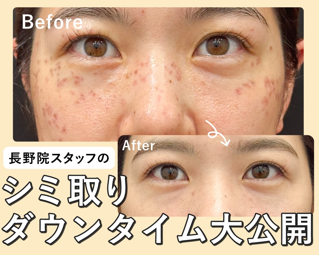 【長野市でシミ取り・シミ治療】長野院スタッフのシミ取りダウンタイム大公開!
