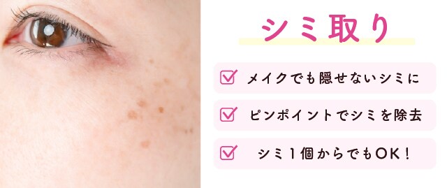 シミ取りレーザー
