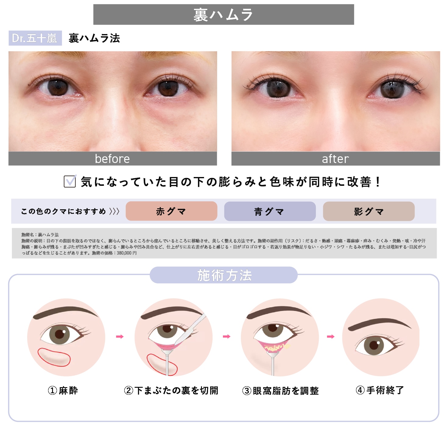 裏ハムラ