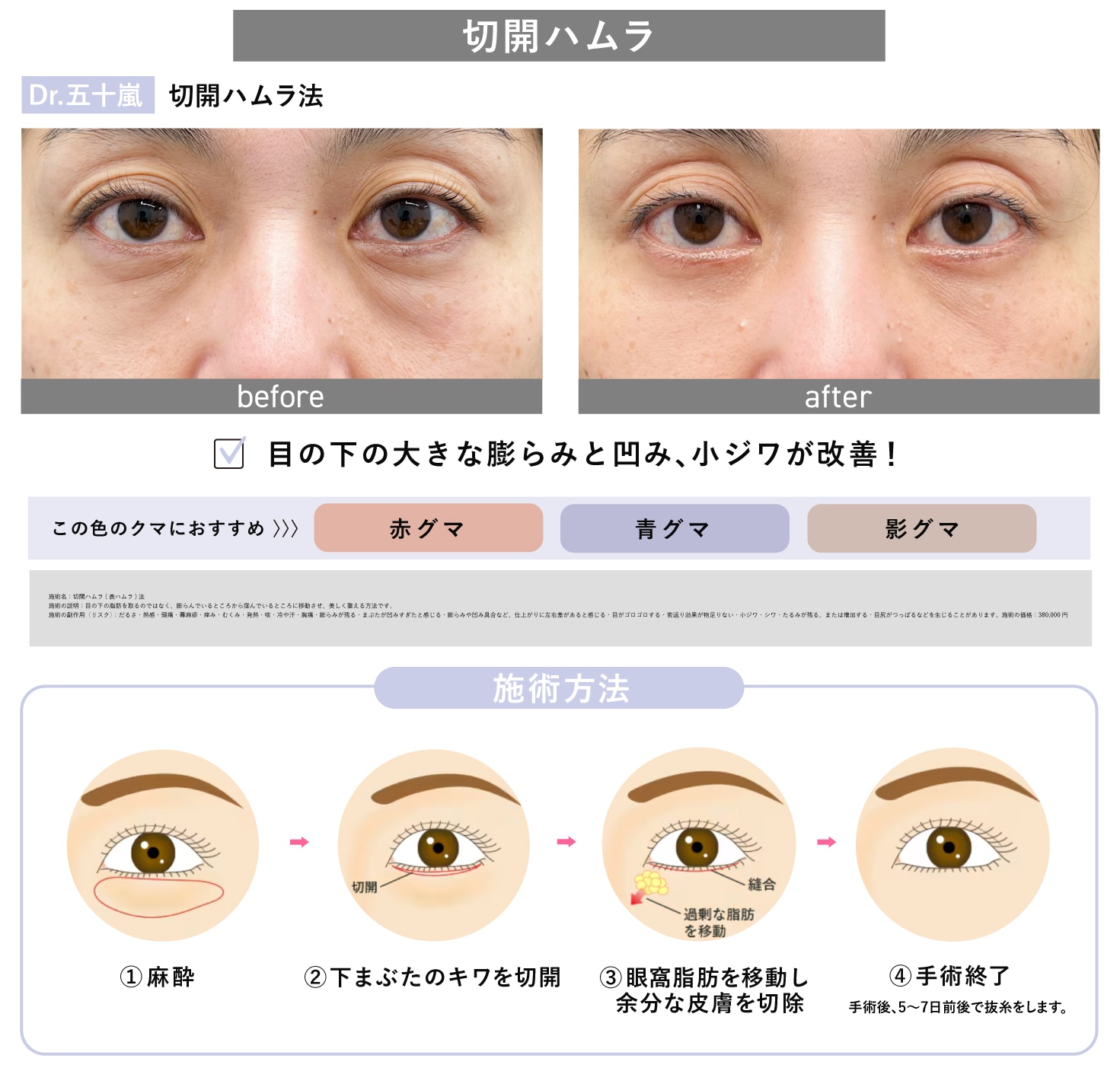 切開ハムラ