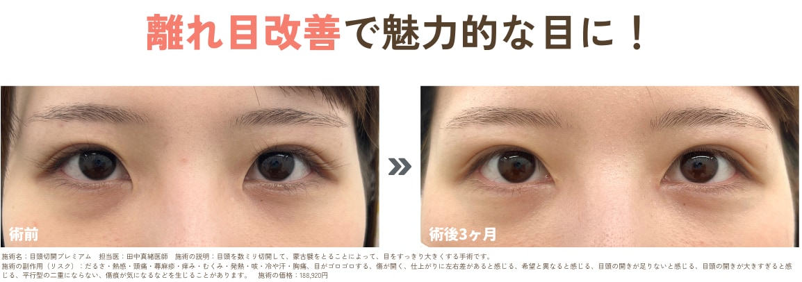 目頭切開プレミアム<br />
