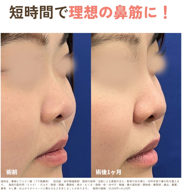 鼻根ヒアルロン酸