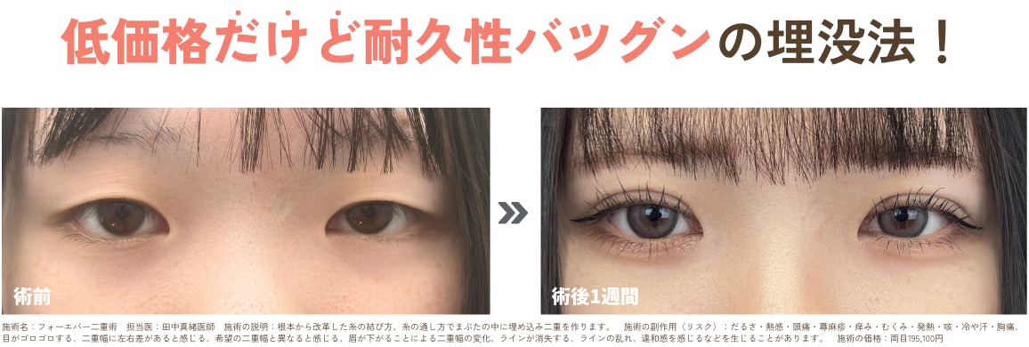 フォーエバー二重術<br />
