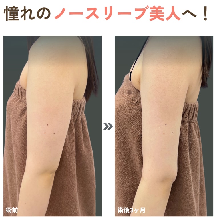  二の腕<br />
