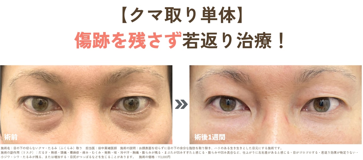 目の下の切らないクマ・たるみ取り