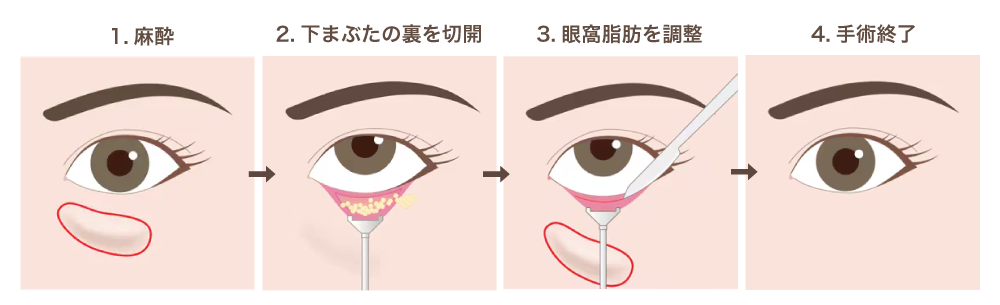 凹みと膨らみを同時に改善！