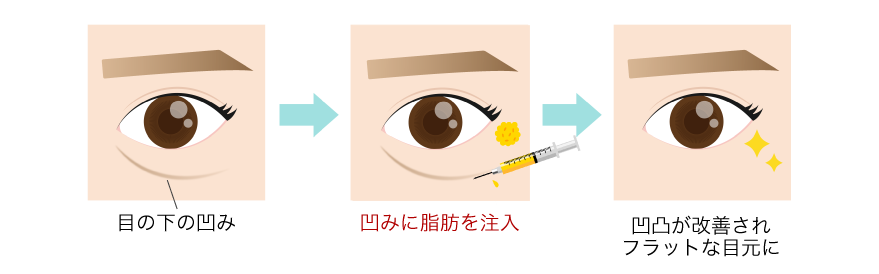 凹んでいる部分にハリを出す
