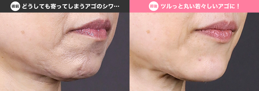 ボコボコとしているシワを改善！