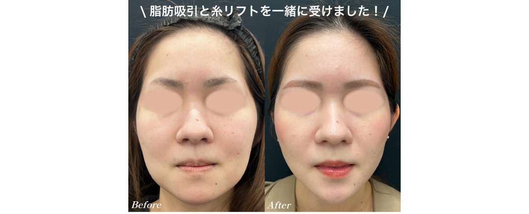 脂肪吸引