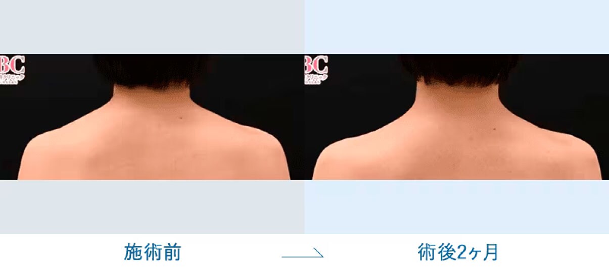 肩・首
