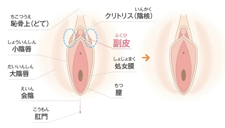 小陰唇の施術を受ける方は同時に副皮の施術も受ける方が多い