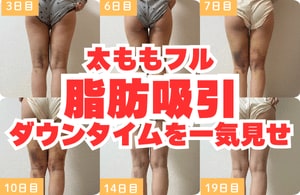 【長崎 脂肪吸引】長崎で脂肪吸引といえば湘南美容クリニック長崎院！気になる太もものダウンタイムを一気見せっ♡