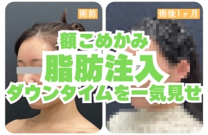【長崎 若返り】究極のエイジングケア。脂肪注入のダウンタイムを大公開！