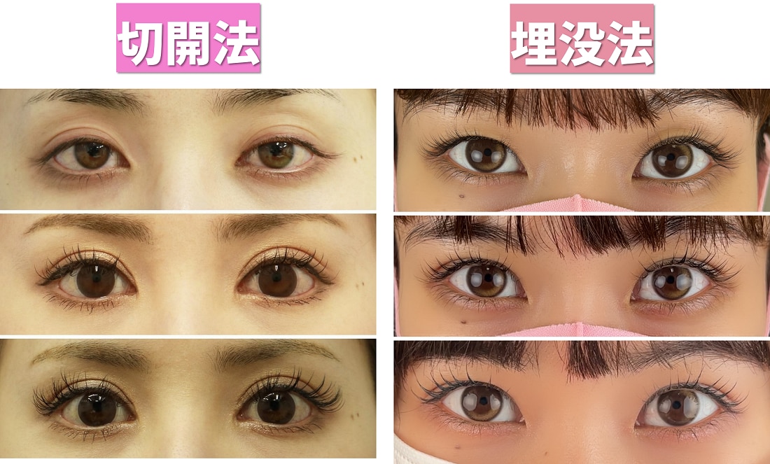 埋没法？切開法？