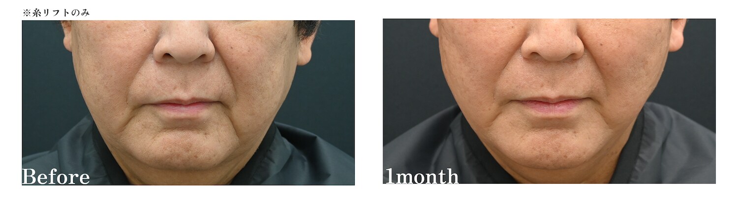 小顔整形をする事で得られる印象の変化は…<br />
