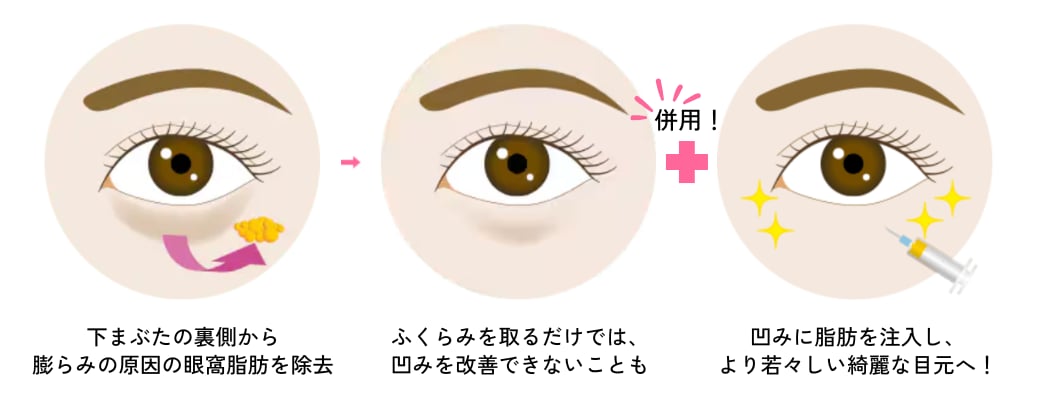 ①脂肪注射（脂肪注入）やPRPを併用する
