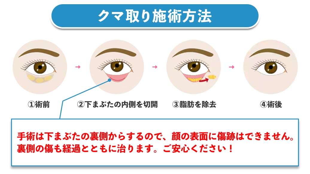 クマ取りの基本【施術方法】