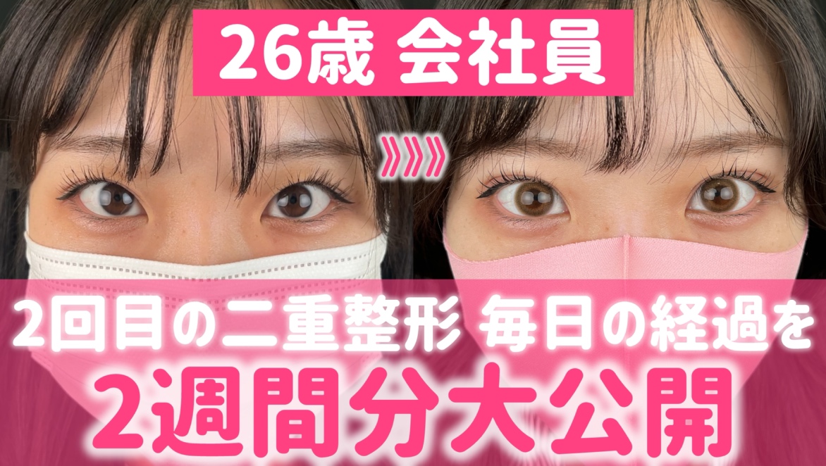 二重整形ダウンタイム