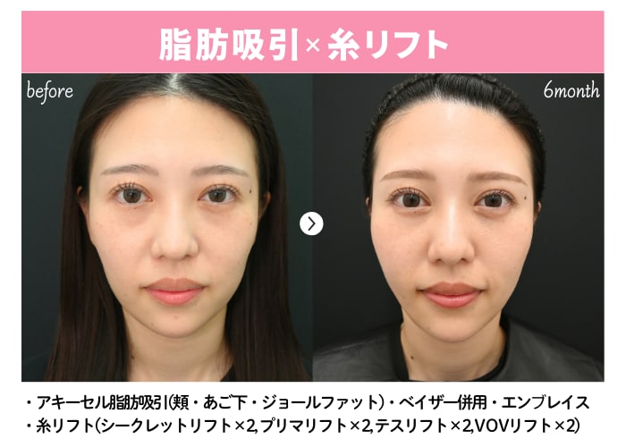 脂肪吸引術前→６ヶ月後の症例