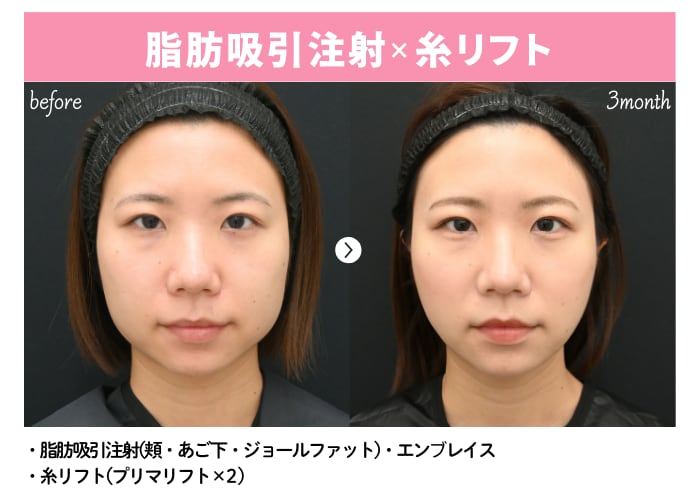 before・after