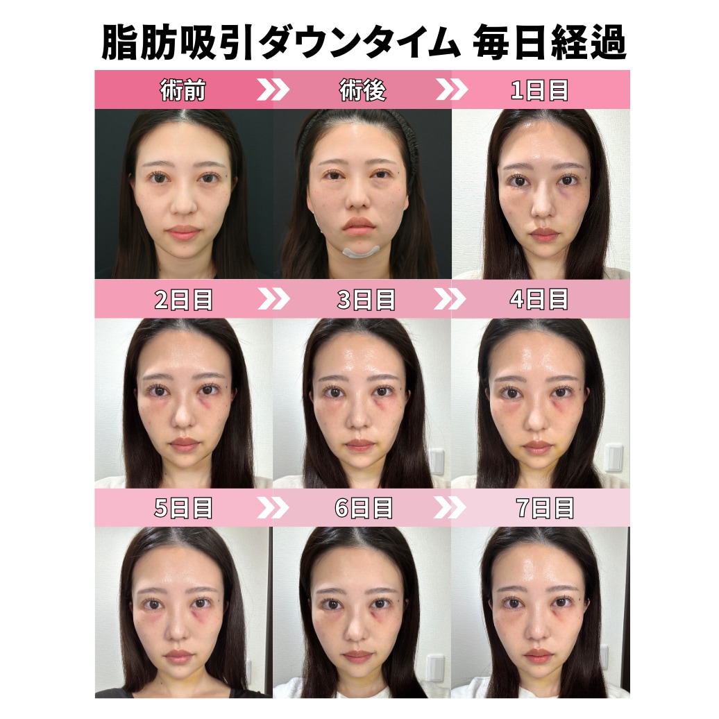 顔の脂肪吸引【術後1〜7日目】