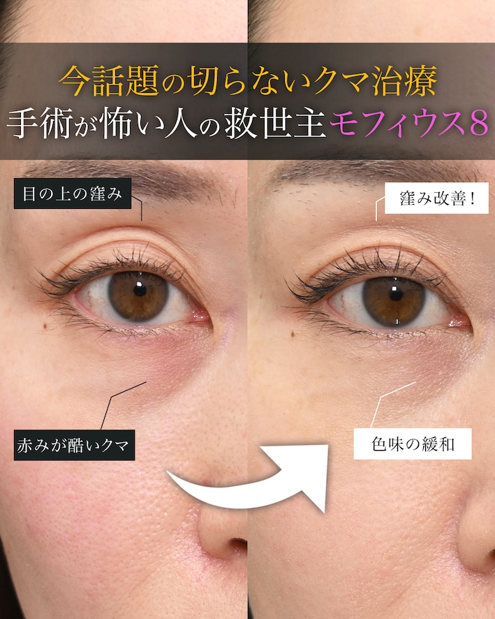 ”切らずに”クマが改善しています！