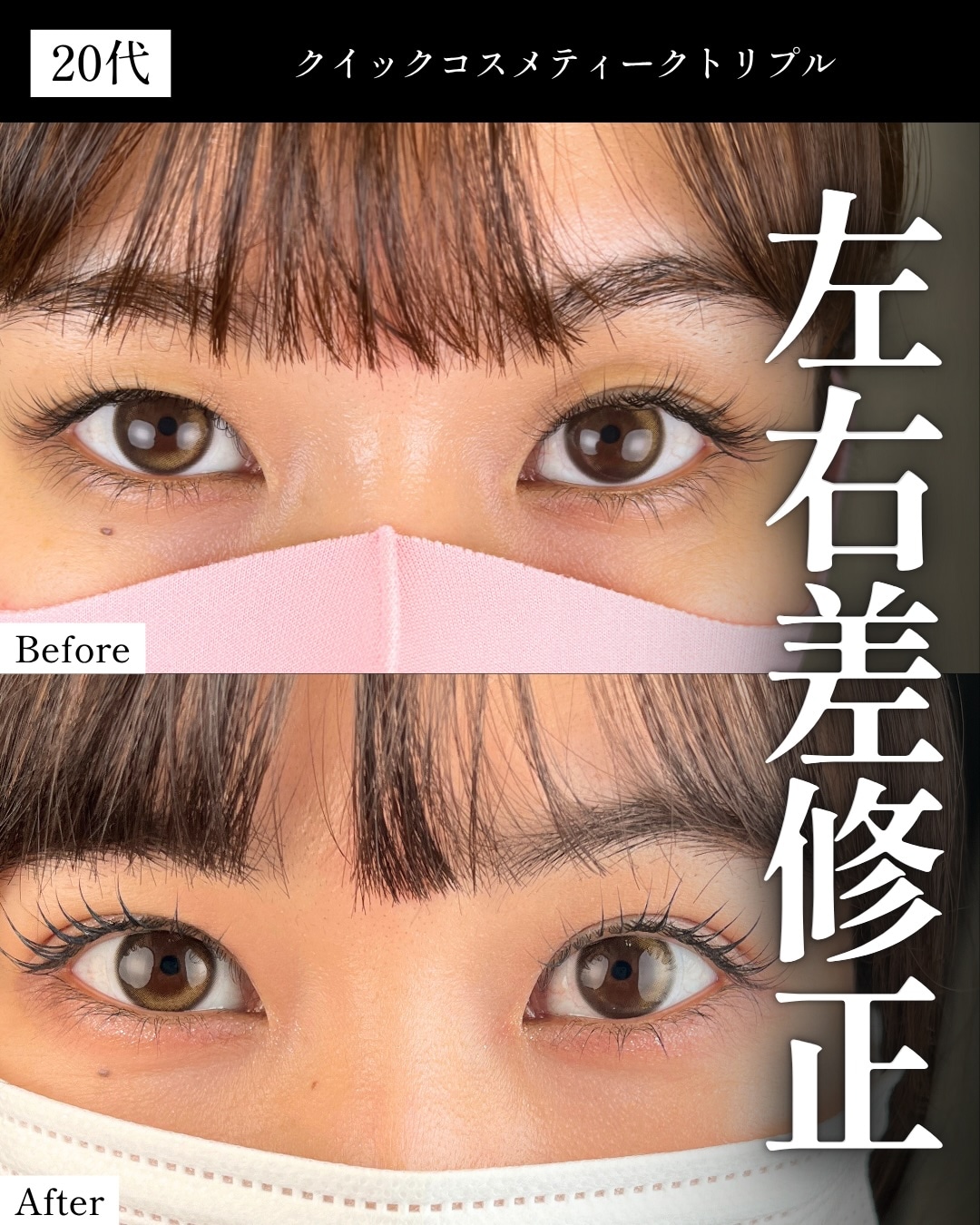 ②二重の幅が不自然（広すぎる・狭すぎる・左右差）
