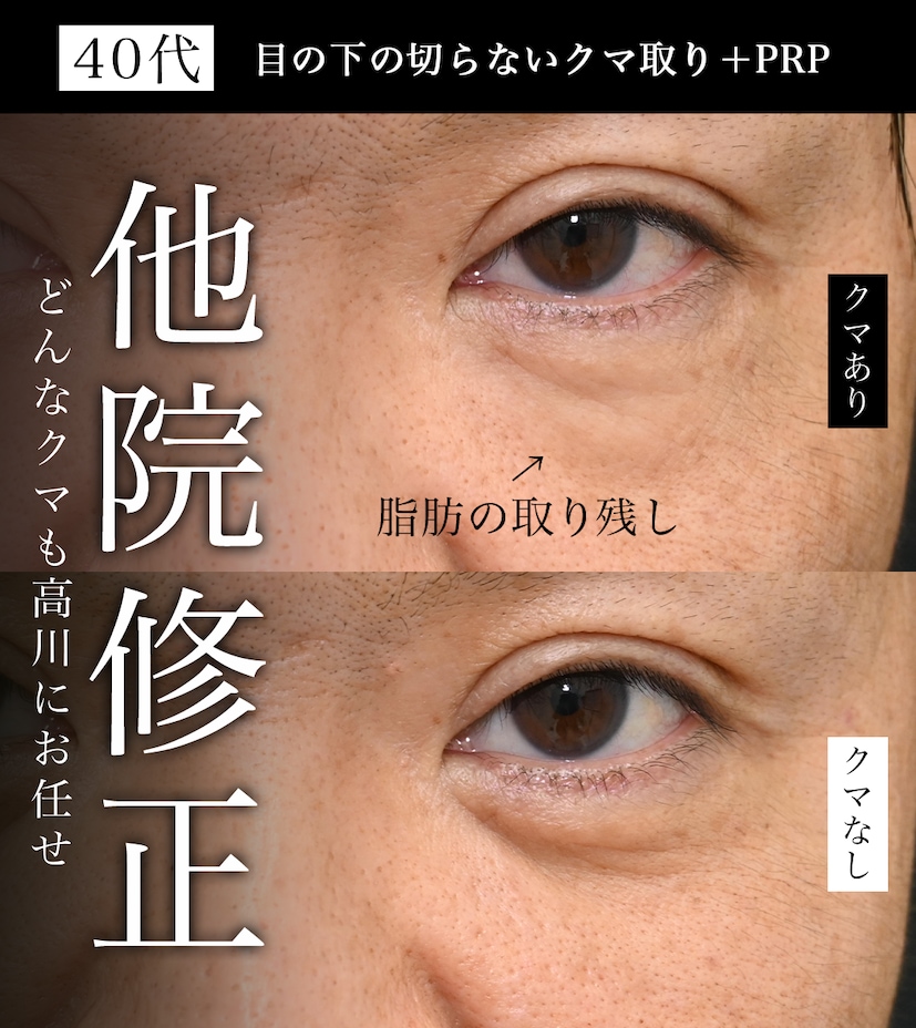 ①効果が実感できなかった（ふくらみが残る・左右差がある）