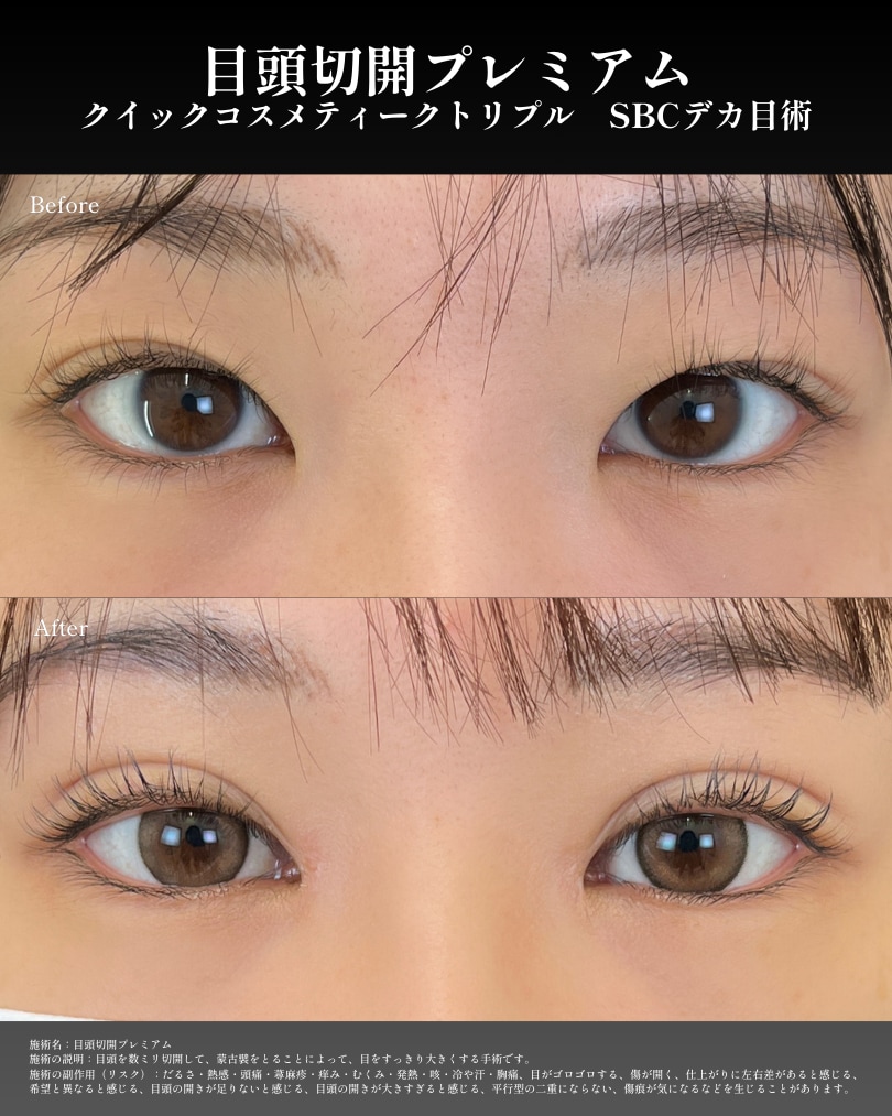 Mix型二重に（二重埋没の修正）