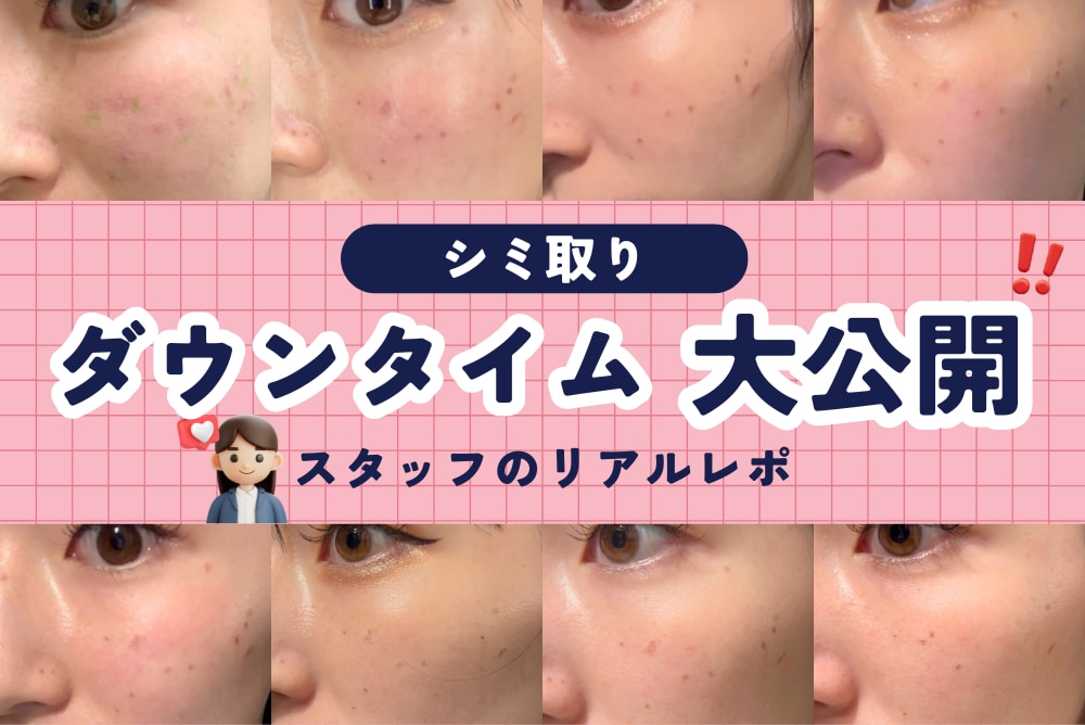 【写真あり】シミ取り（ピコスポット）のダウンタイムを正直レポ｜実際どうだった？