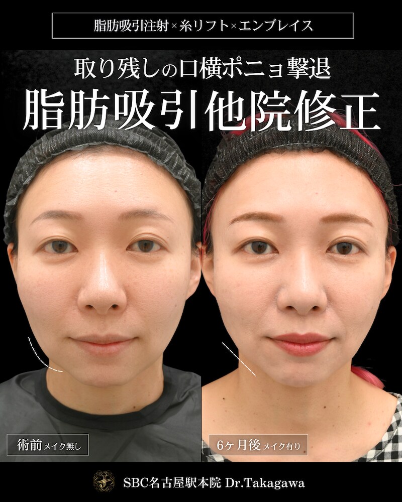 ①脂肪の取り残しがある