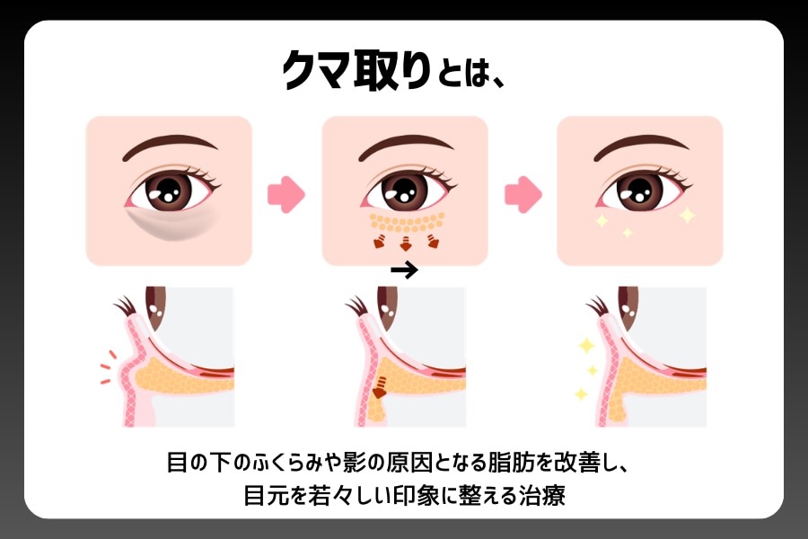 クマ取りとは
