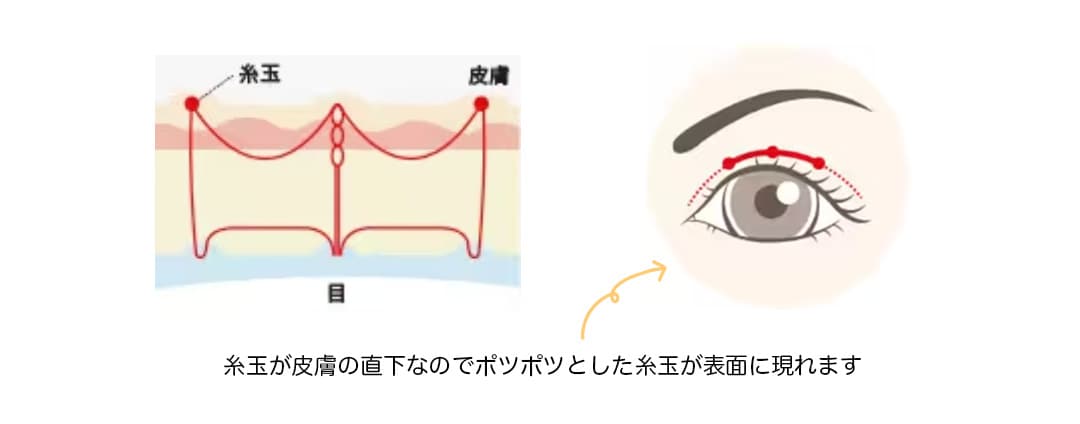フォーエバー二重術