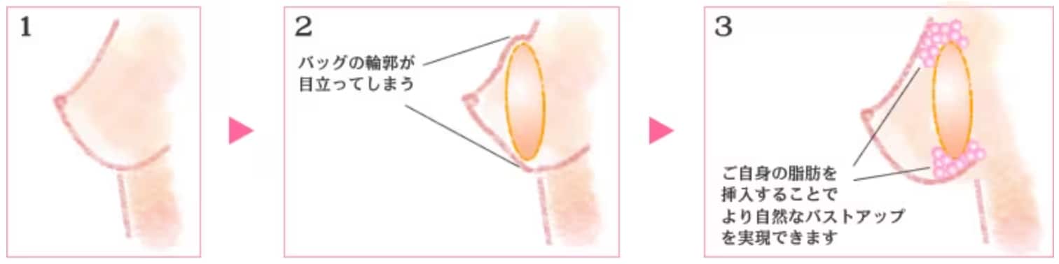 ハイブリッド豊胸