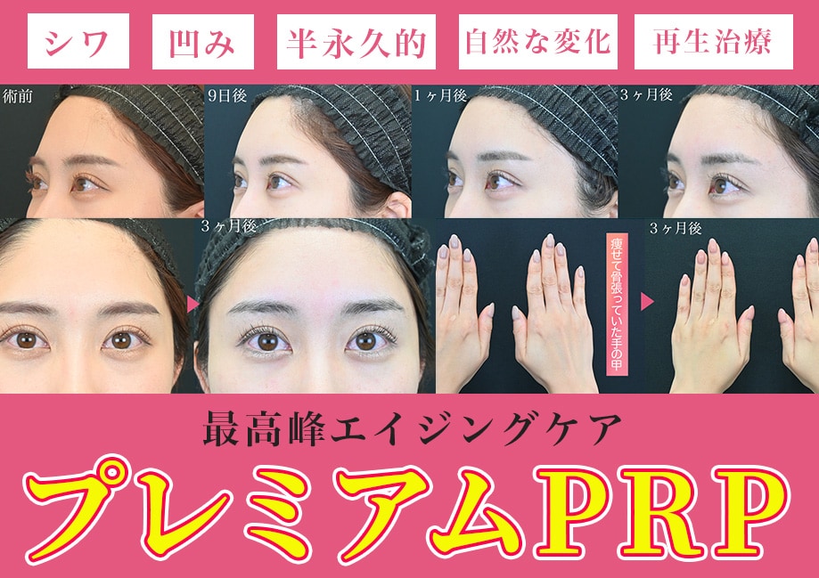 【プレミアムPRP】実際に名古屋院スタッフが若返り治療を受けました！ダウンタイムを大公開＃湘南美容クリニック