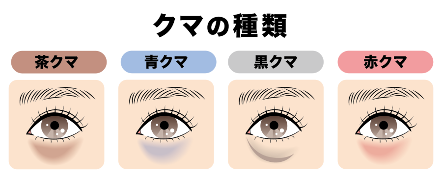 あなたのクマはどのタイプ？原因と見分け方