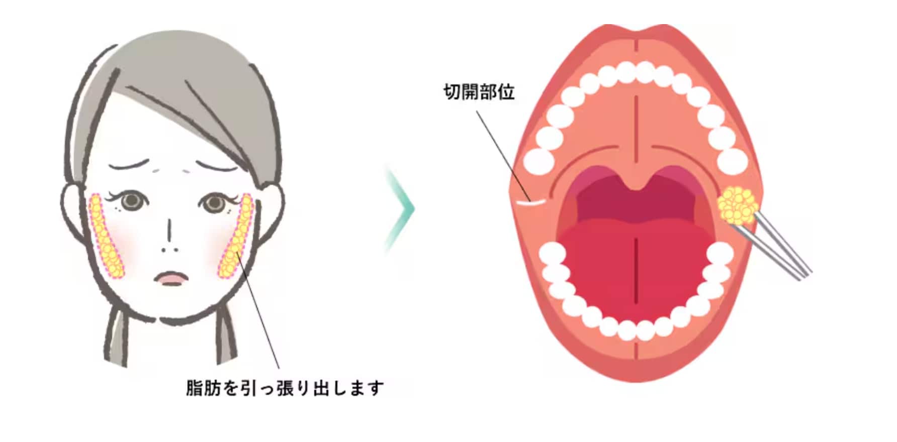 『口の中で吸える、噛んでしまう脂肪』『笑った時につまめる脂肪』