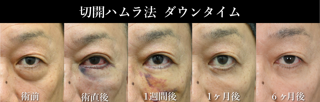 切開ハムラ法（表ハムラ）
