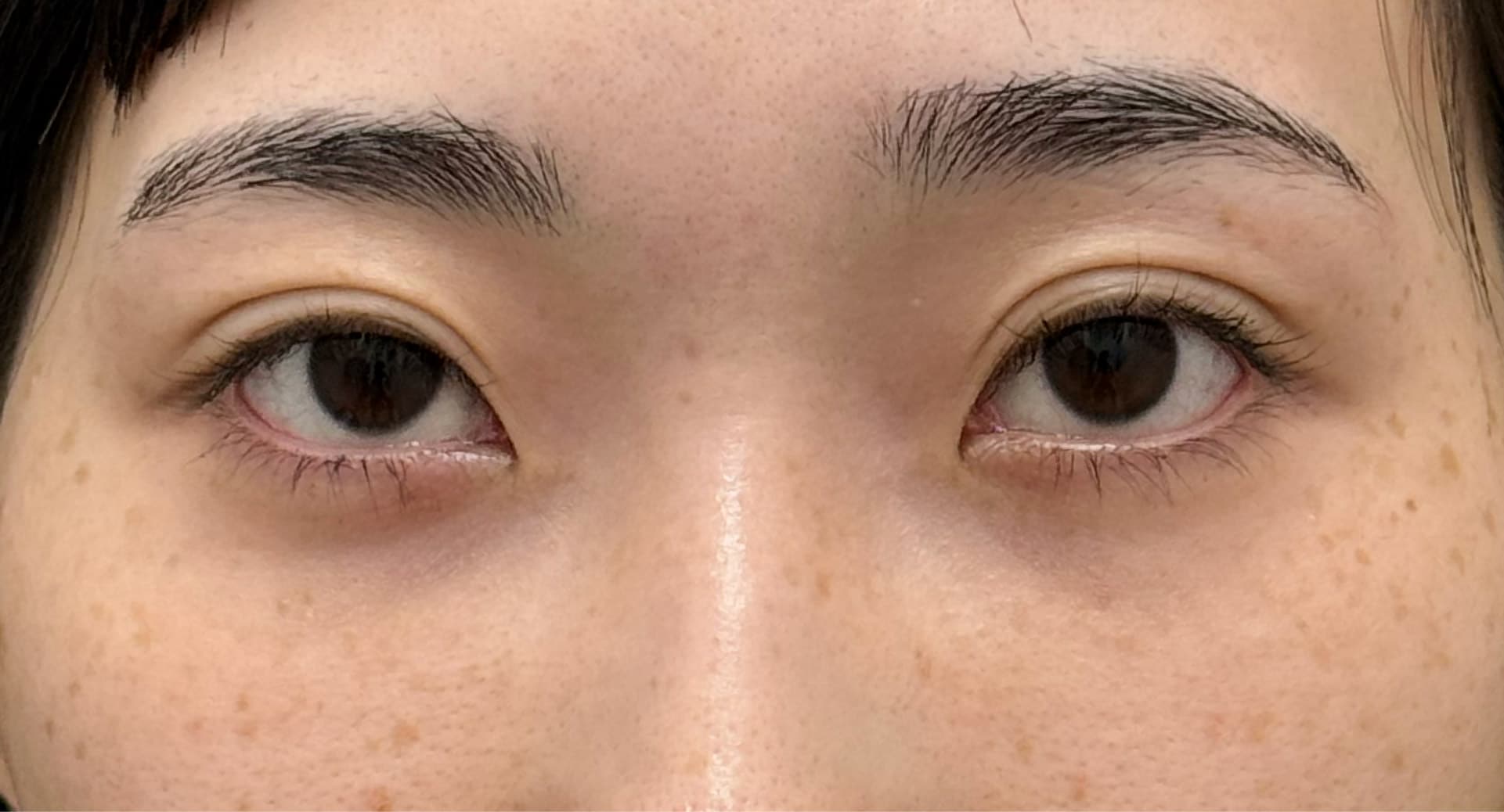 【中部地区で裏ハムラ法できる女医は数名！】<br />
美的センスが光る女医のクマ取り