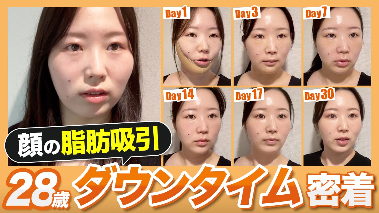 【顔フル整形密着】口元のもたつき・頬のたるみが消える！ダウンタイム全て見せます！