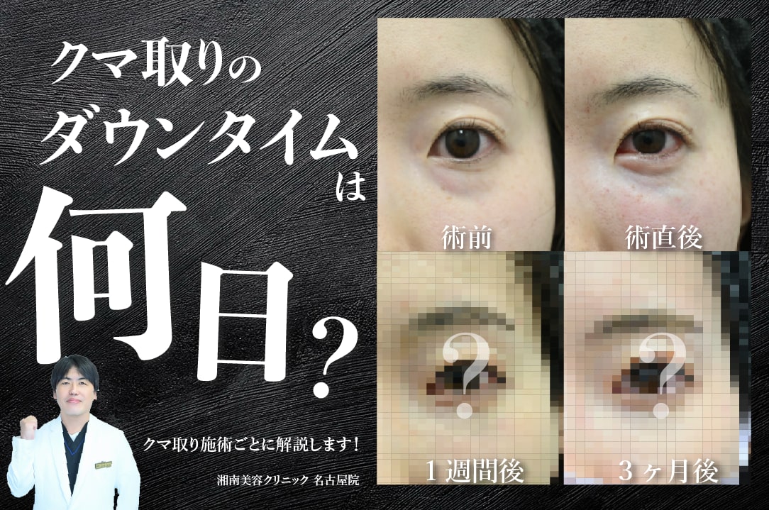 【名古屋院】クマ取りのダウンタイムは何日？｜【施術別】腫れ・痛み・メイクの可否を徹底解説