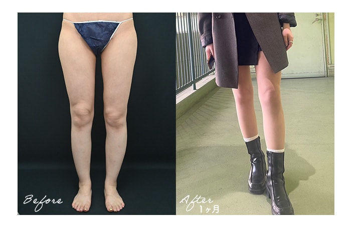 太ももの脂肪吸引レポートはいかがでしたか？
