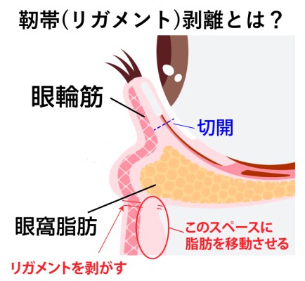 「靭帯（リガメント）を剥がす」とは？ なぜ重要なのか？